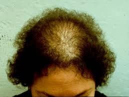 movehs - Alopecia